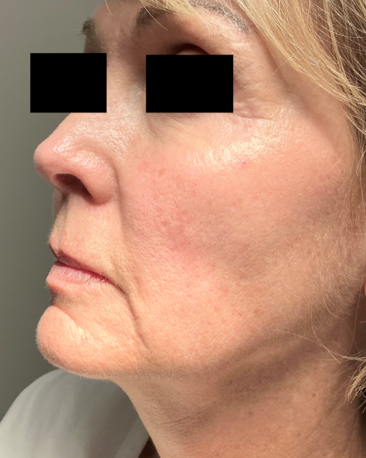 Ear repair, 3 month follow up