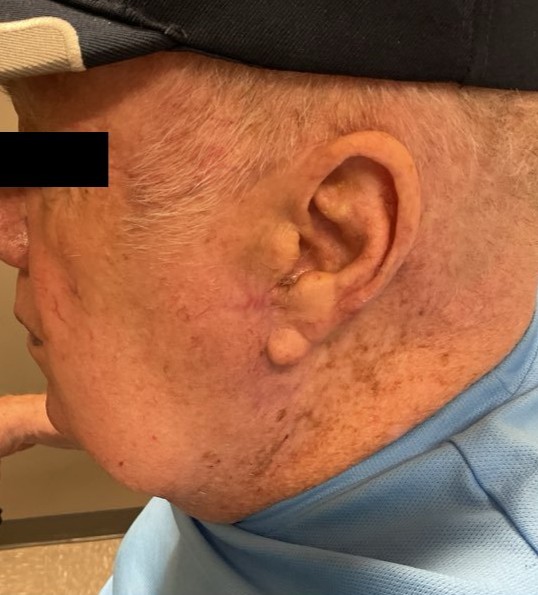 Cheek repair, 3 month follow up