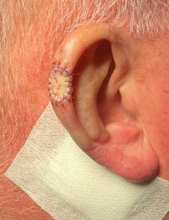 Ear reconstruction, suture photo