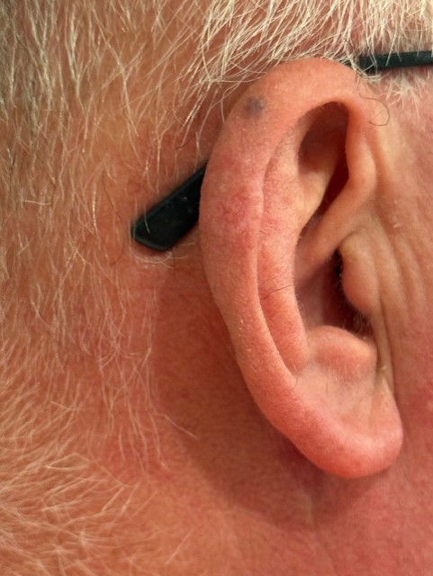 Ear reconstruction, 1 month follow up