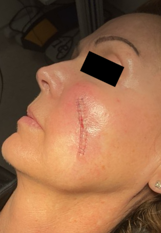 Ear repair, suture photo