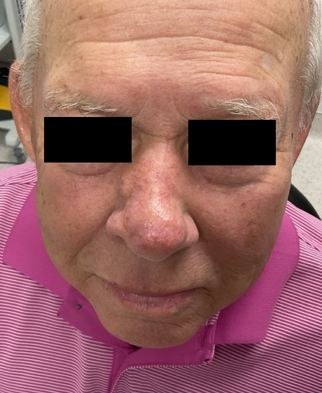 Nose repair, 3 month follow up