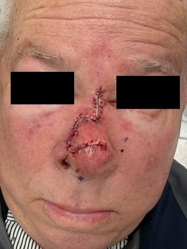 Nose repair, suture photo